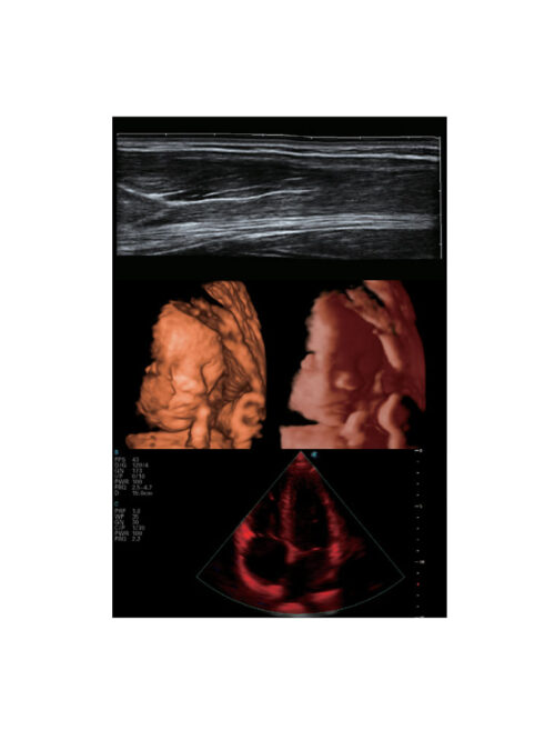 ultrasound-machine-p15-4 SonoScape P15 - Enhance Your Ultrasound Exam