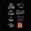 ultrasound-machine-p15-5 SonoScape P15 - Enhance Your Ultrasound Exam