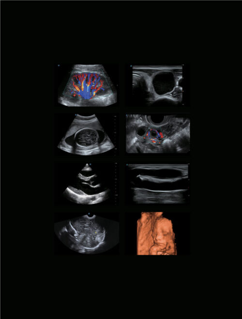 ultrasound-machine-p15-5 SonoScape P15 - Enhance Your Ultrasound Exam